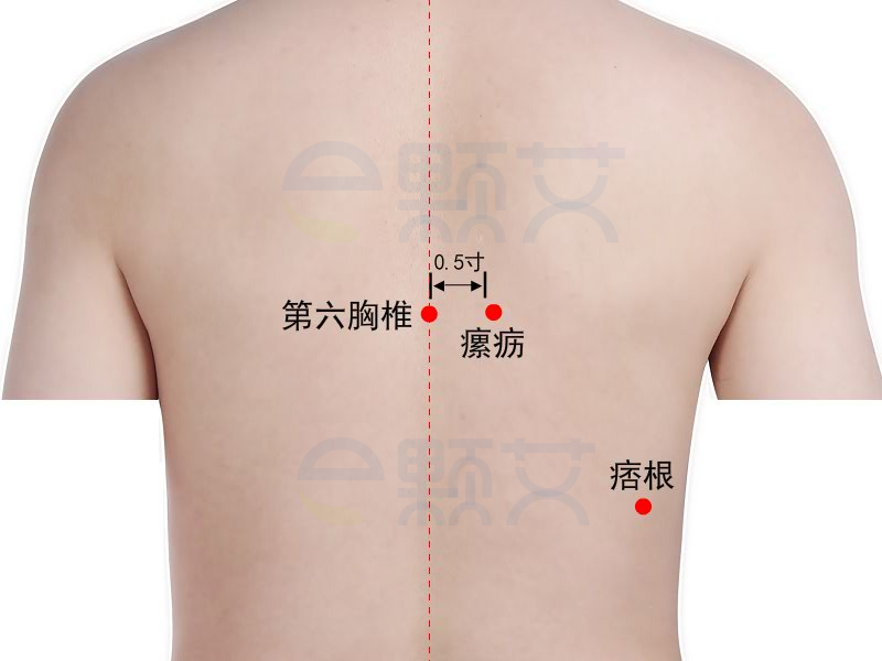 瘰疬穴位图 艾灸取穴方法 主治病症 应用经验