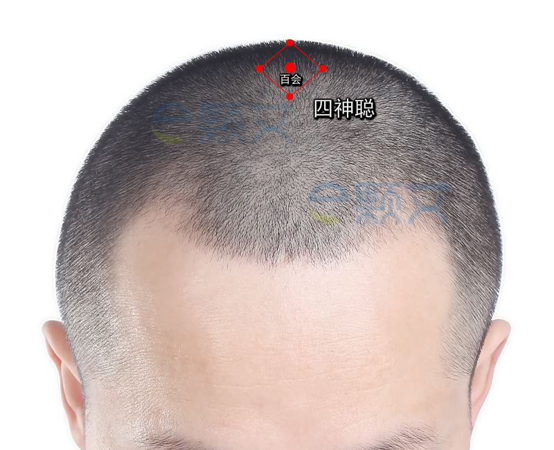四神聪穴位图 艾灸取穴方法 主治病症 应用经验